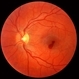 Valsalva retinopathy mild Valsalva retinopathy mild