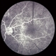 Choroidal Osteoma 3 Choroidal Osteoma 3