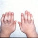 Blau syndrome slide 3