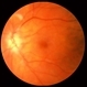 Anterior ischemic optic neuropathy slide 1 Anterior ischemic optic neuropathy slide 1