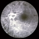 Anterior ischemic optic neuropathy slide 2 Anterior ischemic optic neuropathy slide 2