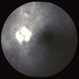 Anterior ischemic optic neuropathy slide 3 Anterior ischemic optic neuropathy slide 3