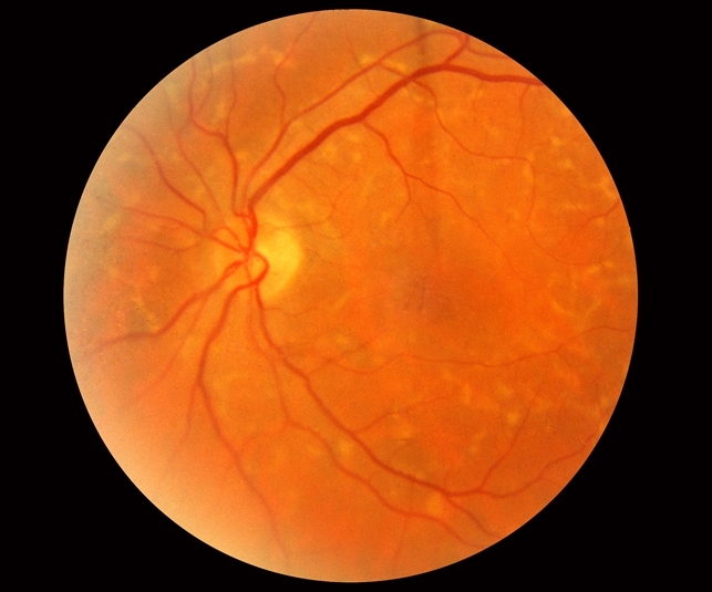 Pattern Dystrophy slide 2 Retina Image Bank