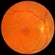 Pattern Dystrophy slide 1 Pattern Dystrophy slide 1
