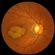 Stargardt macular dystrophy slide 1 Stargardt macular dystrophy slide 1