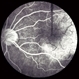 Choroidal Osteoma 4 Choroidal Osteoma 4