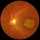 Stargardt macular dystrophy slide 2 Stargardt macular dystrophy slide 2