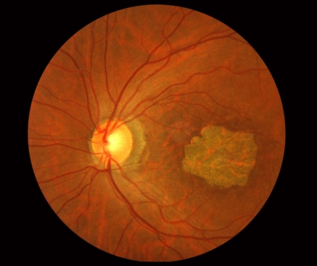 Stargardt macular dystrophy slide 2 Retina Image Bank