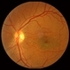 Stargardt macular dystrophy slide 2 Stargardt macular dystrophy slide 2