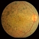 Retinitis pigmentosa AR slide 1 Retinitis pigmentosa AR slide 1