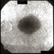 Retinitis pigmentosa AD Slide 5 Retinitis pigmentosa AD Slide 5