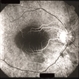 Retinitis pigmentosa AD Slide 4 Retinitis pigmentosa AD Slide 4