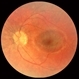 Retinitis pigmentosa AD Slide 1 Retinitis pigmentosa AD Slide 1