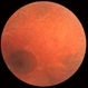 Retinitis pigmentosa AD Slide 2 Retinitis pigmentosa AD Slide 2