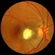 Ocular Toxocariasis slide 1 Ocular Toxocariasis slide 1
