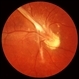 Ocular Toxocariasis slide 1 Ocular Toxocariasis slide 1