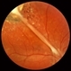 Ocular Toxocariasis slide 2 Ocular Toxocariasis slide 2