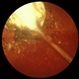Ocular Toxocariasis slide 3 Ocular Toxocariasis slide 3