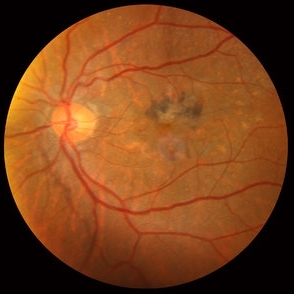 Deferoxamine retinopathy - Retina Image Bank