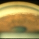 Sarcoidosis Panuveitis Slide 3 Sarcoidosis Panuveitis Slide 3
