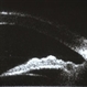 Sarcoidosis Panuveitis Slide 4 Sarcoidosis Panuveitis Slide 4