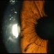 Sarcoidosis Panuveitis Slide 2 Sarcoidosis Panuveitis Slide 2