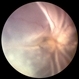 PVR Retinal Detachment with subretinal bands Slide 1 PVR Retinal Detachment with subretinal bands Slide 1