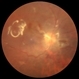 PVR Retinal Detachment with subretinal bands Slide 2 PVR Retinal Detachment with subretinal bands Slide 2