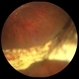 PVR Retinal Detachment with subretinal bands Slide 3 PVR Retinal Detachment with subretinal bands Slide 3