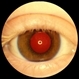 X-linked ocular albinism slide 1 X-linked ocular albinism slide 1