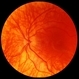 X-linked ocular albinism slide 3 X-linked ocular albinism slide 3