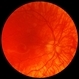 X-linked ocular albinism slide 2 X-linked ocular albinism slide 2