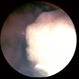 Retinoblastoma Retinoblastoma