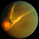 Chronic Retinal Detachment: Features Slide 2 Chronic Retinal Detachment: Features Slide 2