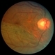 Chronic Retinal Detachment: Features Slide 1 Chronic Retinal Detachment: Features Slide 1
