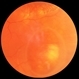 Chronic Retinal Detachment: Features Slide 3 Chronic Retinal Detachment: Features Slide 3