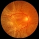 PVR Retinal Detachment following Laser Retinopexy Slide 1 PVR Retinal Detachment following Laser Retinopexy Slide 1