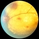 Coats Disease Slide 1 Coats Disease Slide 1