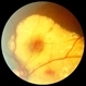 Coats Disease Slide 2 Coats Disease Slide 2