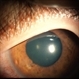 IOFB-Endophthalmitis Slide 1 IOFB-Endophthalmitis Slide 1