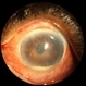 Bleb-related Endophthalmitis Slide 1