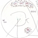 PVR Retinal Detachment following Laser Retinopexy Slide 2 PVR Retinal Detachment following Laser Retinopexy Slide 2