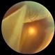 Giant Retinal Tear Slide 1 Giant Retinal Tear Slide 1