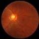 Giant Retinal Tear Slide 2 Giant Retinal Tear Slide 2