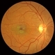 Stargardt macular dystrophy slide 1 Stargardt macular dystrophy slide 1