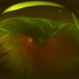 Giant Retinal Tear Giant Retinal Tear
