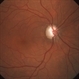 Primary Open Angle Glaucoma - Excavated Disc Primary Open Angle Glaucoma - Excavated Disc