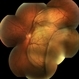 Choroidal Melanoma Large Amelanotic Choroidal Melanoma Large Amelanotic