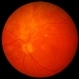 Cytomegalovirus Retinitis, Healed Cytomegalovirus Retinitis, Healed