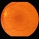 Macular Hole Macular Hole